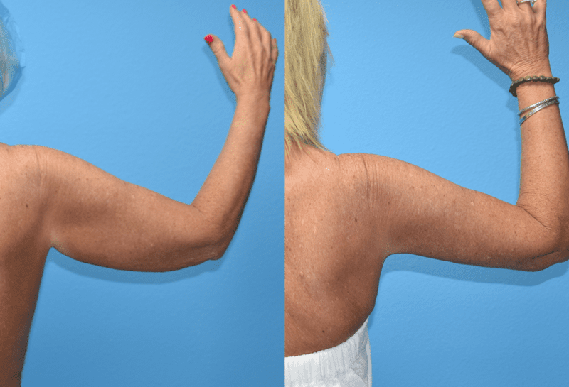 Arm Lift results by Dr. Maningas at Maningas Cosmetic Surgery in Joplin, MO