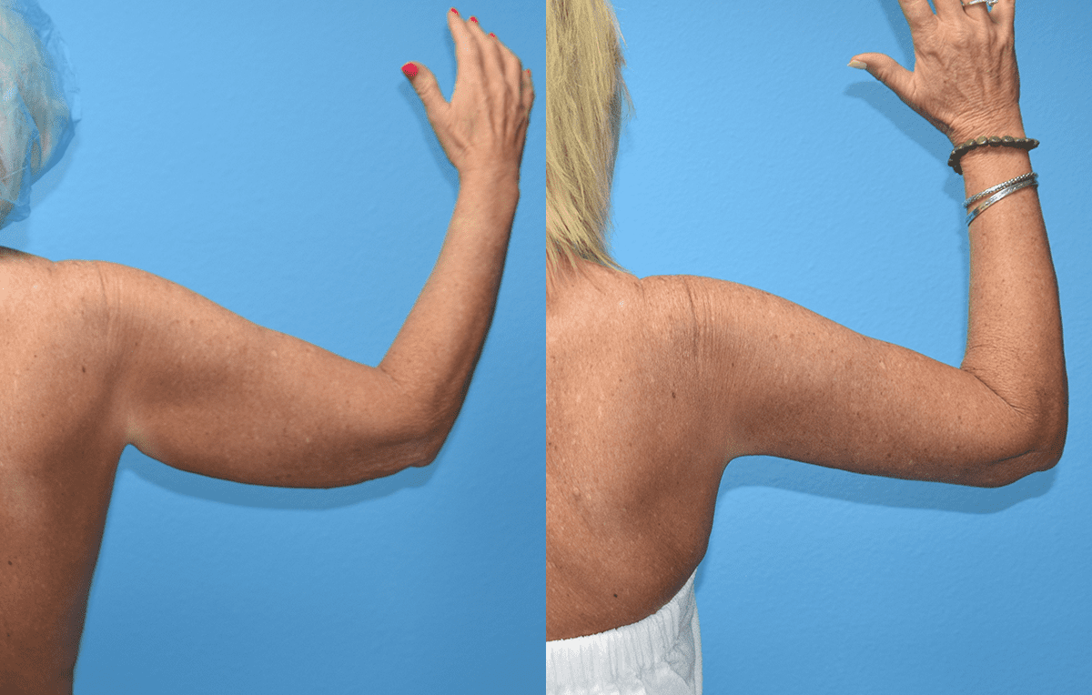 Arm Lift results by Dr. Maningas at Maningas Cosmetic Surgery in Joplin, MO