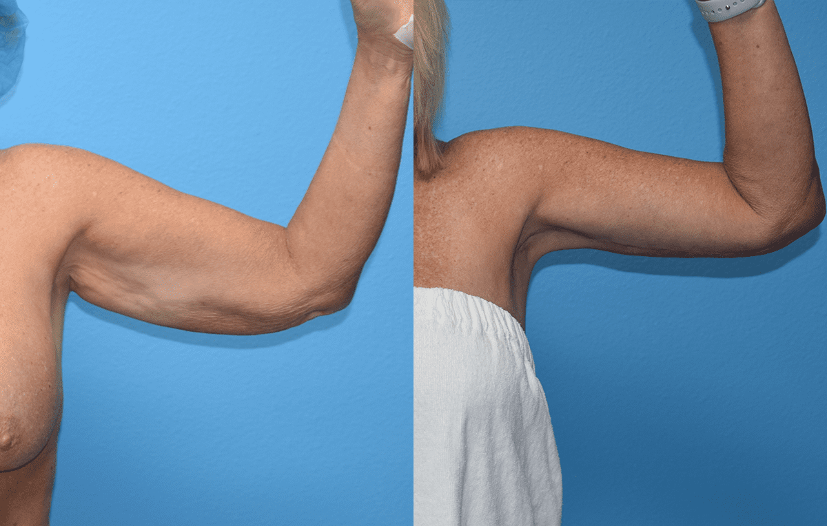 Arm Lift results by Dr. Maningas at Maningas Cosmetic Surgery in Joplin, MO