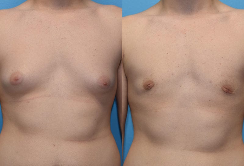 Gynecomastia Repair, or Male Breast Reduction, results by Dr. Maningas at Maningas Cosmetic Surgery in Joplin, MO and Northwest Arkansas