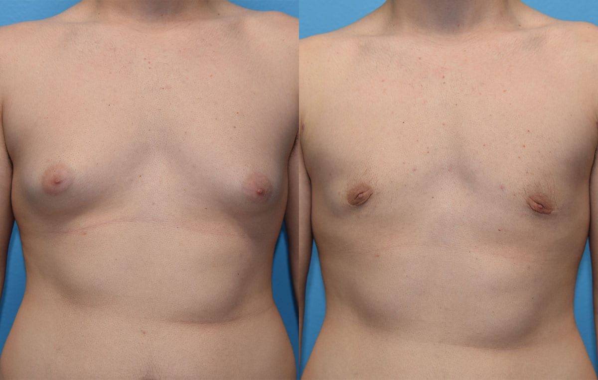 Gynecomastia Repair, or Male Breast Reduction, results by Dr. Maningas at Maningas Cosmetic Surgery in Joplin, MO and Northwest Arkansas