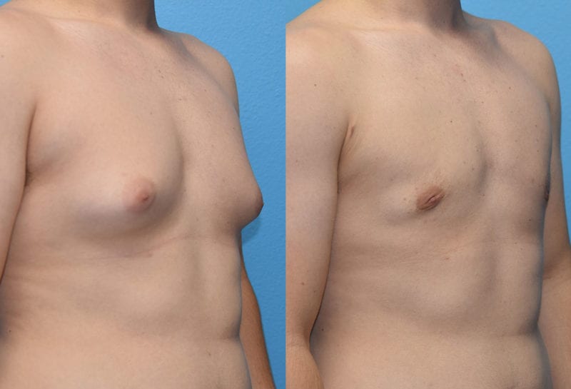 Gynecomastia Repair, or Male Breast Reduction, results by Dr. Maningas at Maningas Cosmetic Surgery in Joplin, MO and Northwest Arkansas