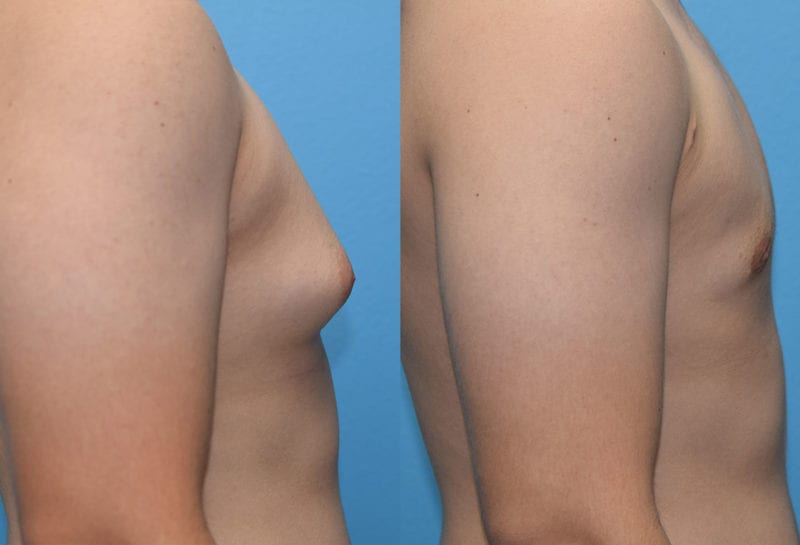 Gynecomastia Repair, or Male Breast Reduction, results by Dr. Maningas at Maningas Cosmetic Surgery in Joplin, MO and Northwest Arkansas