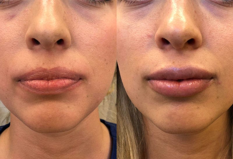 Lip Filler in Joplin, MO at Maningas Cosmetics Surgery