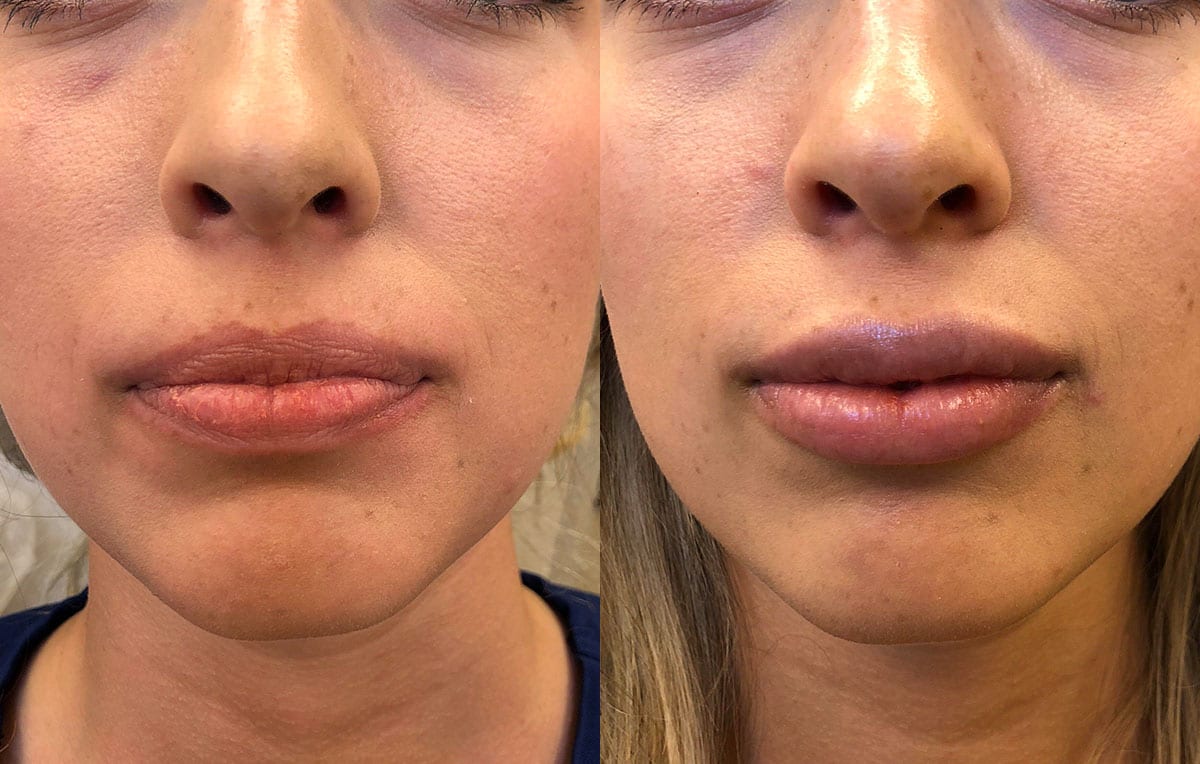 Lip Filler in Joplin, MO at Maningas Cosmetics Surgery