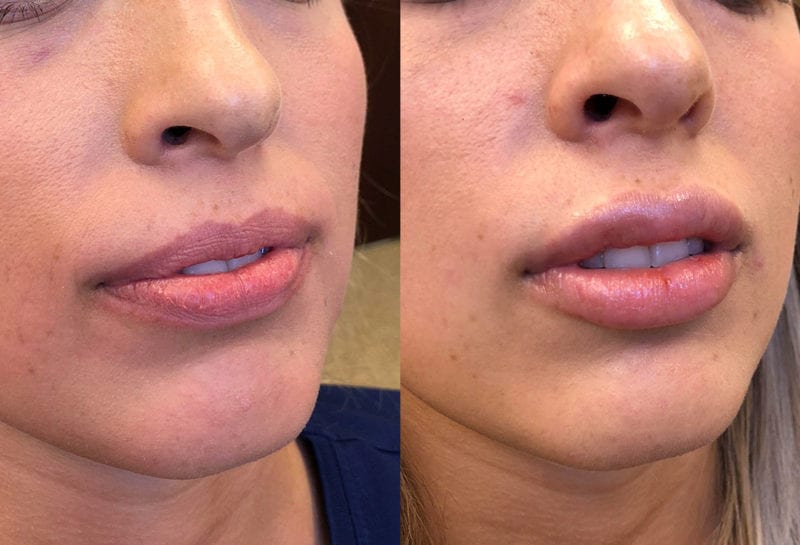 Lip Filler in Joplin, MO at Maningas Cosmetics Surgery