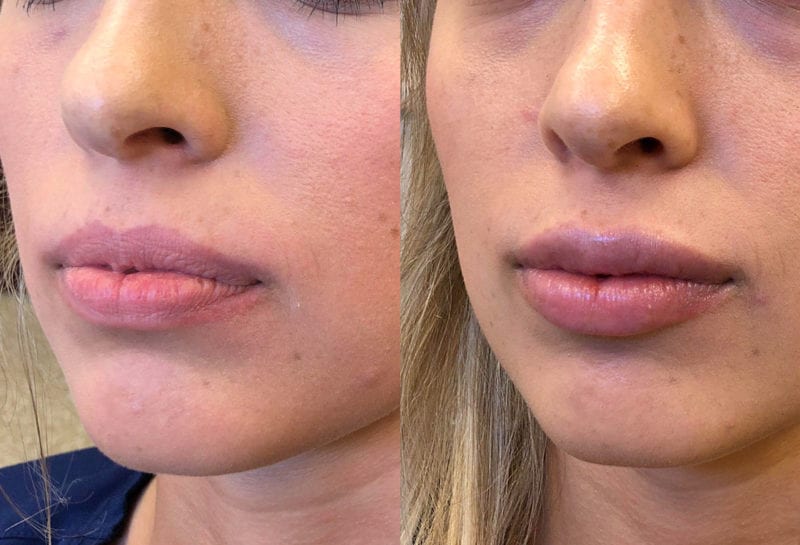 Lip Filler in Joplin, MO at Maningas Cosmetics Surgery