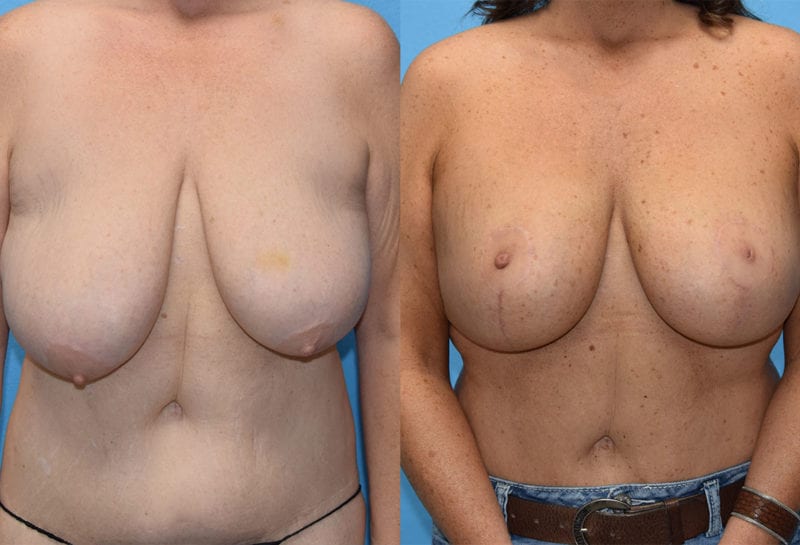 Breast Lift with Implant results by Dr. Maningas at Maningas Cosmetic Surgery in Missouri and Arkansas