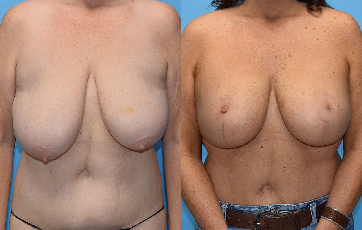 Breast Lift with Implant results by Dr. Maningas at Maningas Cosmetic Surgery in Missouri and Arkansas