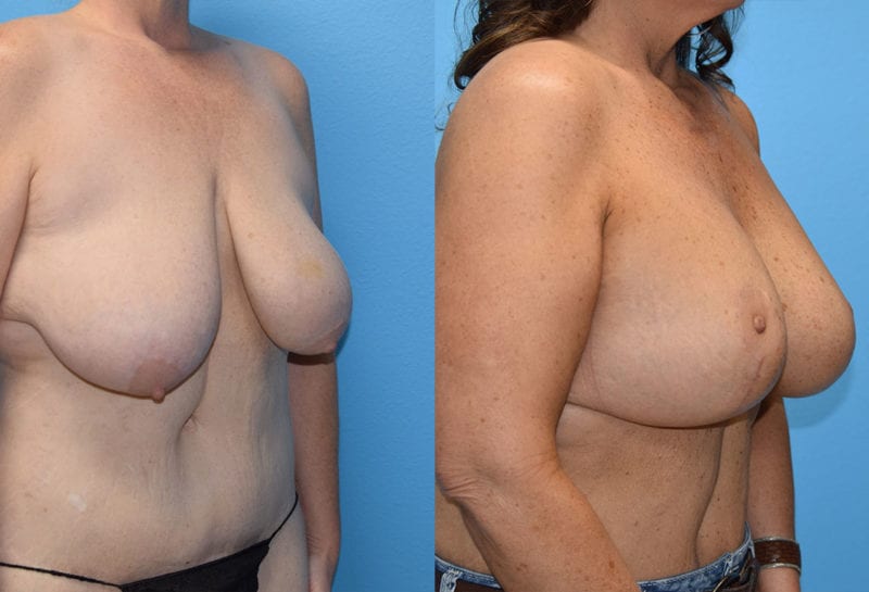 Breast Lift with Implant results by Dr. Maningas at Maningas Cosmetic Surgery in Missouri and Arkansas