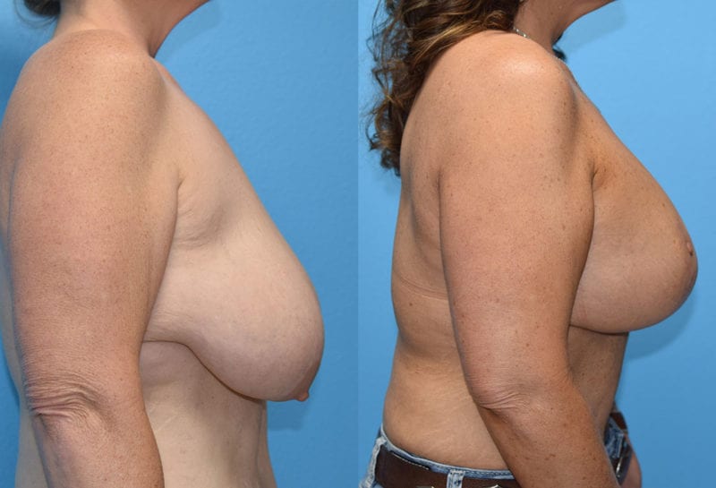 Breast Lift with Implant results by Dr. Maningas at Maningas Cosmetic Surgery in Missouri and Arkansas