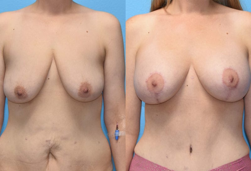 Breast Lift with Implant results by Dr. Maningas at Maningas Cosmetic Surgery in Missouri and Arkansas