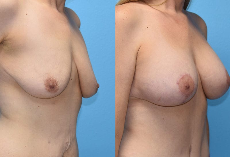 Breast Lift with Implant results by Dr. Maningas at Maningas Cosmetic Surgery in Missouri and Arkansas