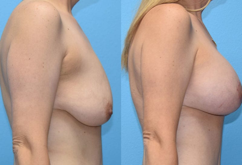 Breast Lift with Implant results by Dr. Maningas at Maningas Cosmetic Surgery in Missouri and Arkansas