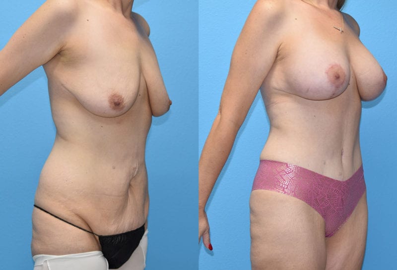 Mommy Makeover results by Dr. Maningas at Maningas Cosmetic Surgery in Joplin, MO