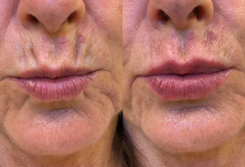 Lip Filler in Joplin, MO at Maningas Cosmetics Surgery