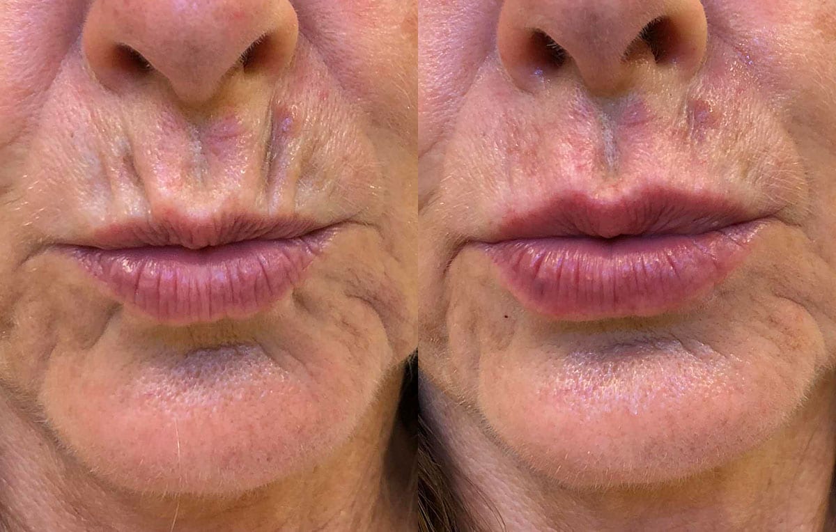 Lip Filler in Joplin, MO at Maningas Cosmetics Surgery