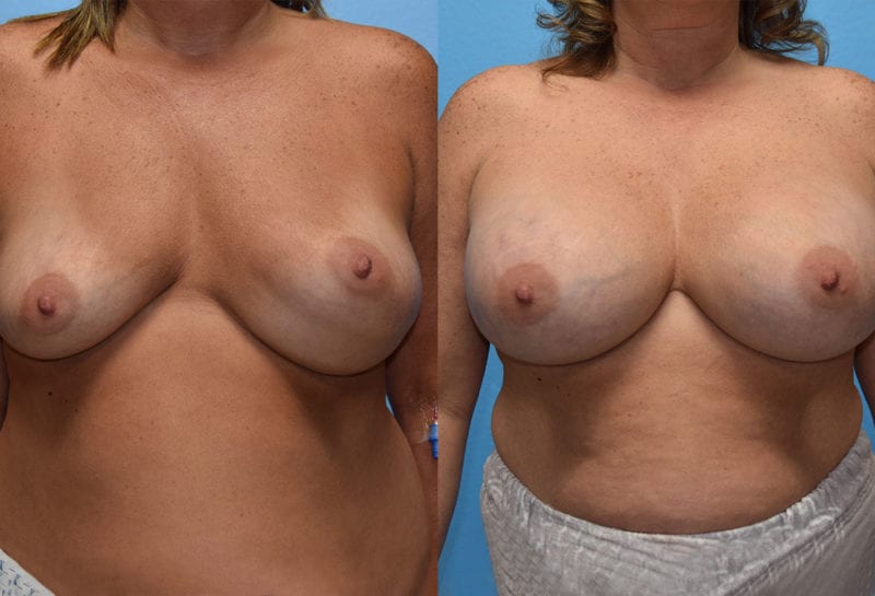 Cosmetic breast revision results by Dr. Maningas at Maningas Cosmetic Surgery in Missouri and Arkansas