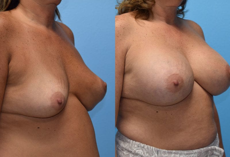 Cosmetic breast revision results by Dr. Maningas at Maningas Cosmetic Surgery in Missouri and Arkansas