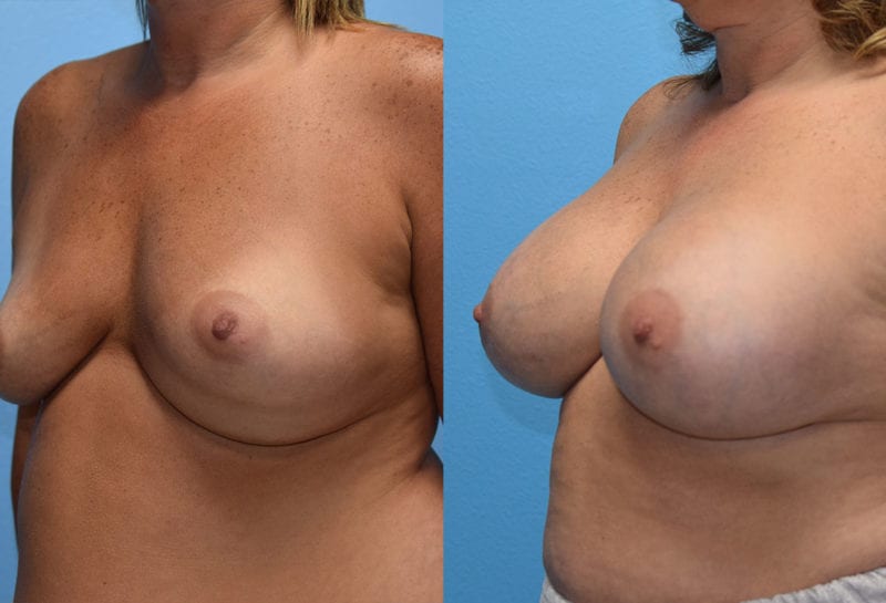 Cosmetic breast revision results by Dr. Maningas at Maningas Cosmetic Surgery in Missouri and Arkansas