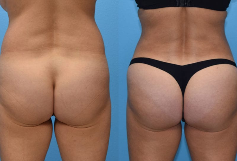 Brazilian Butt Lift by Dr. Maningas at Maningas Cosmetic Surgery in Joplin, MO