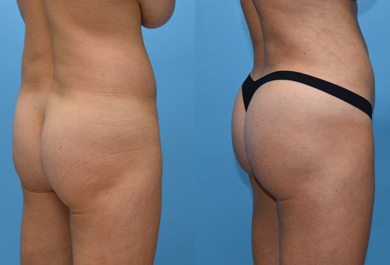 Brazilian Butt Lift by Dr. Maningas at Maningas Cosmetic Surgery in Joplin, MO