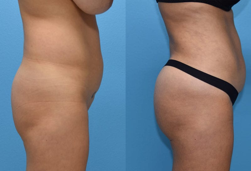 Brazilian Butt Lift by Dr. Maningas at Maningas Cosmetic Surgery in Joplin, MO