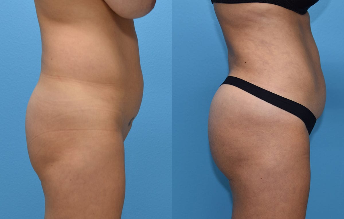 Brazilian Butt Lift by Dr. Maningas at Maningas Cosmetic Surgery in Joplin, MO