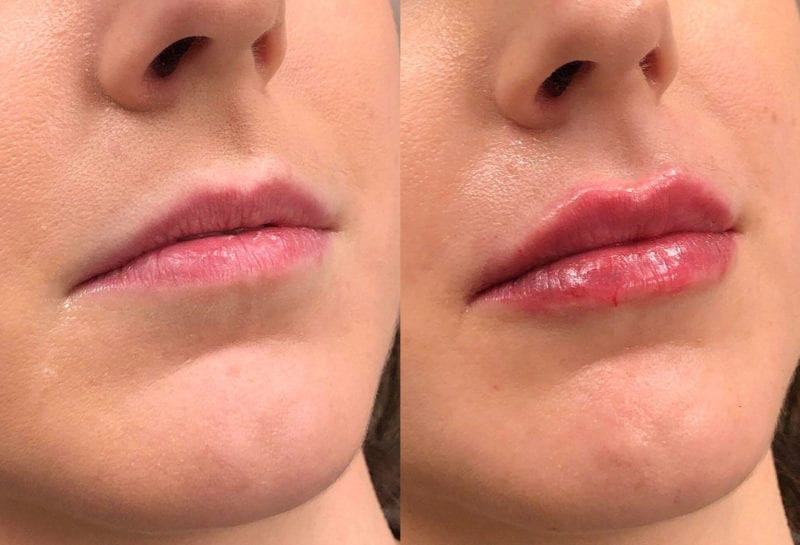 Lip Filler in Joplin, MO at Maningas Cosmetics Surgery