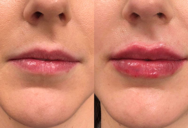 Lip Filler in Joplin, MO at Maningas Cosmetics Surgery