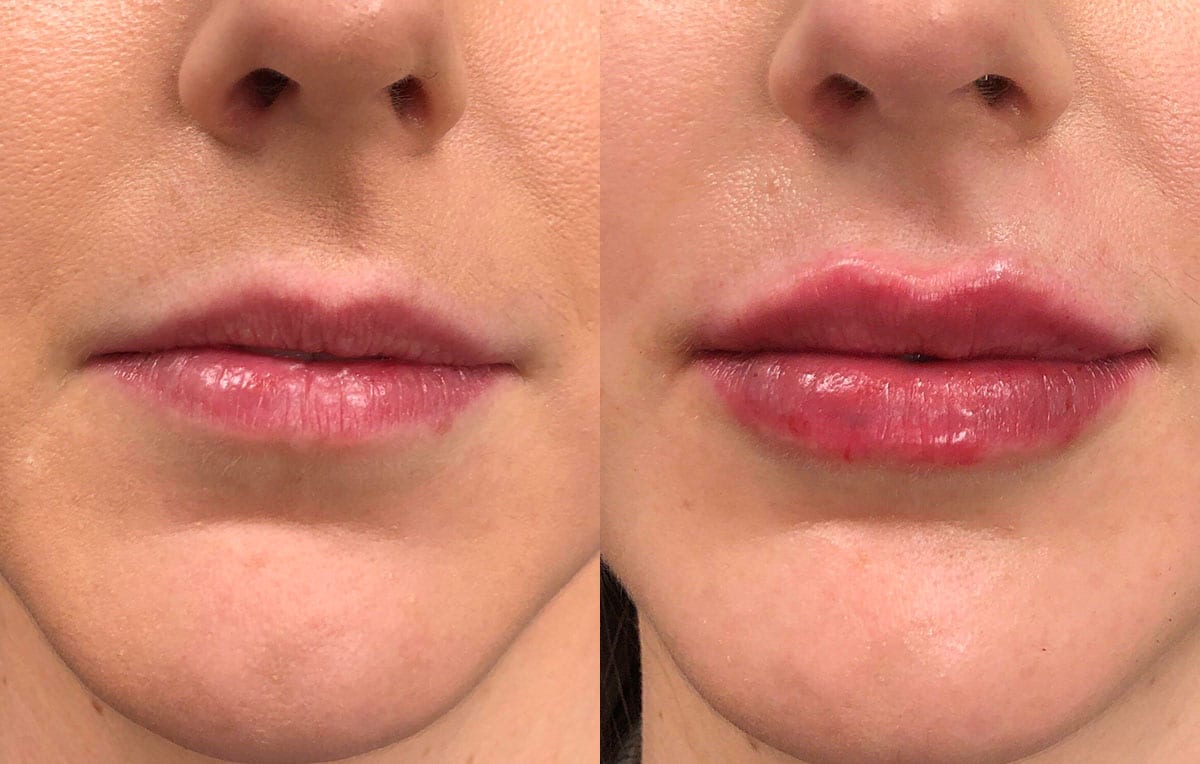 Lip Filler in Joplin, MO at Maningas Cosmetics Surgery