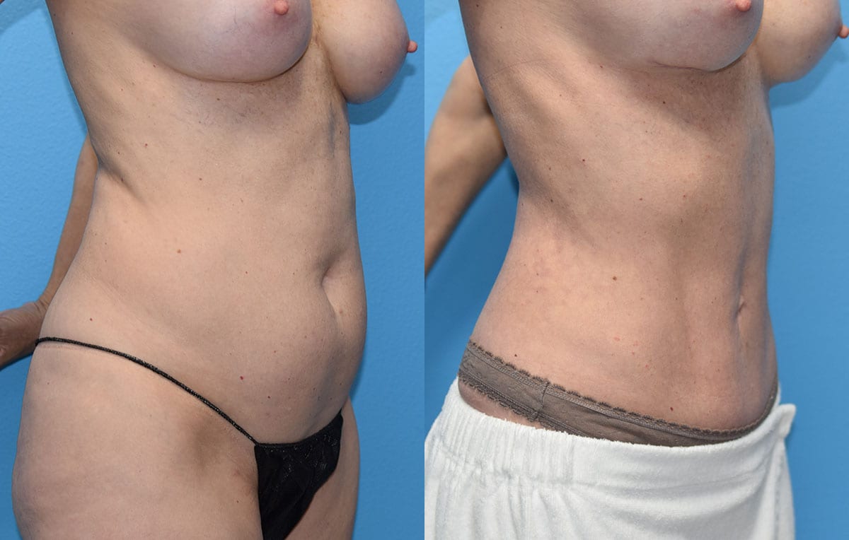 Mini Tummy Tuck results by Dr. Maningas at Maningas Cosmetic Surgery in Joplin, MO and Northwest Arkansas.