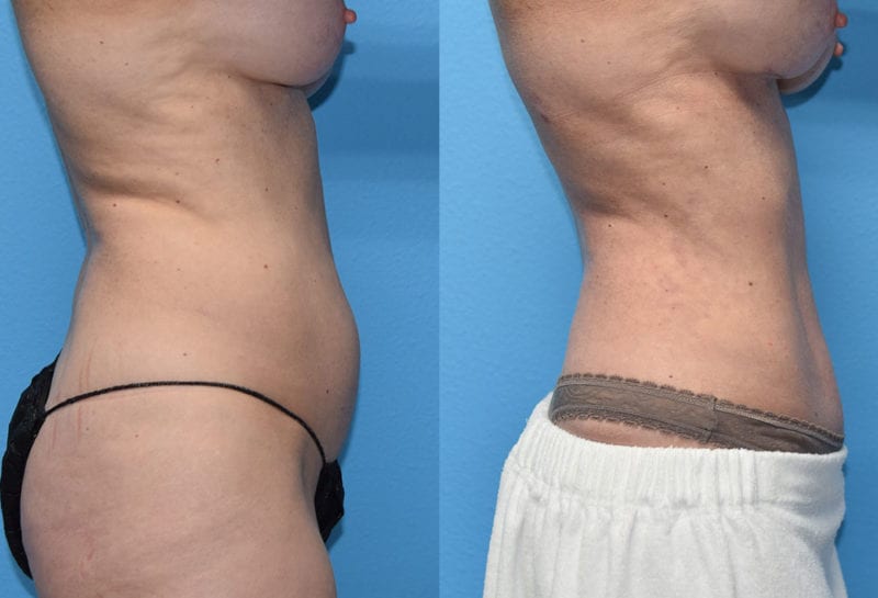 Mini Tummy Tuck results by Dr. Maningas at Maningas Cosmetic Surgery in Joplin, MO and Northwest Arkansas.