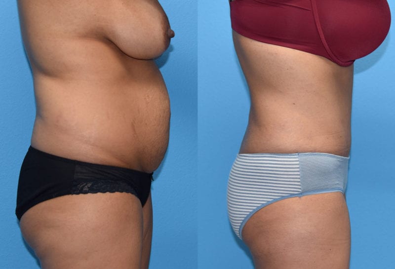 Tummy tuck results by Dr. Maningas at Maningas Cosmetic Surgery in Joplin, MO