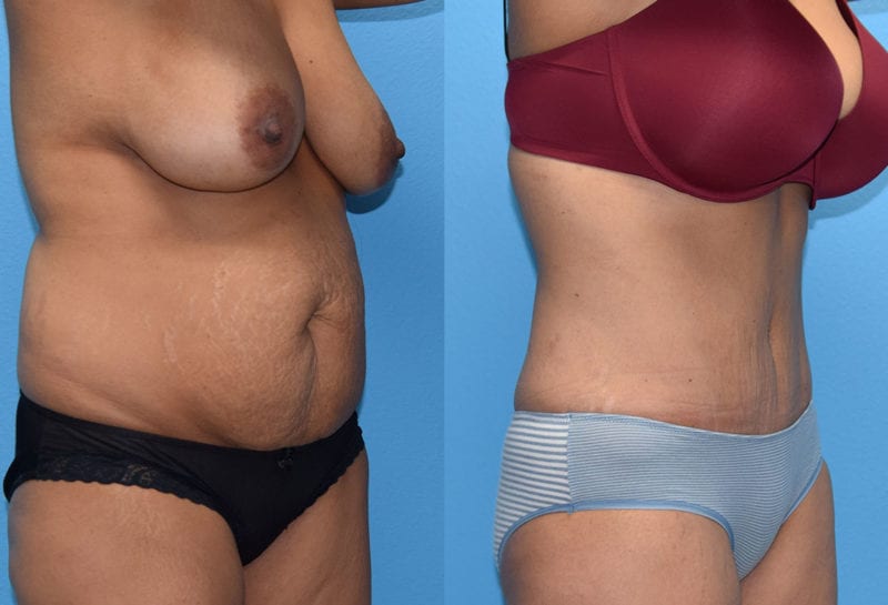 Tummy tuck results by Dr. Maningas at Maningas Cosmetic Surgery in Joplin, MO