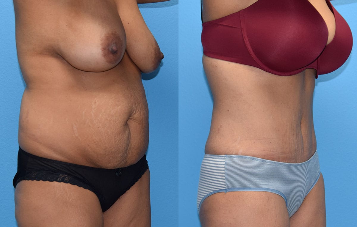 Tummy tuck results by Dr. Maningas at Maningas Cosmetic Surgery in Joplin, MO