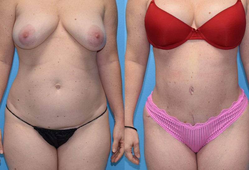 Tummy tuck results by Dr. Maningas at Maningas Cosmetic Surgery in Joplin, MO