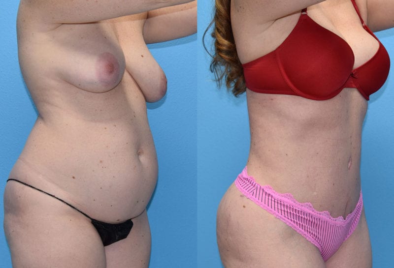 Tummy tuck results by Dr. Maningas at Maningas Cosmetic Surgery in Joplin, MO