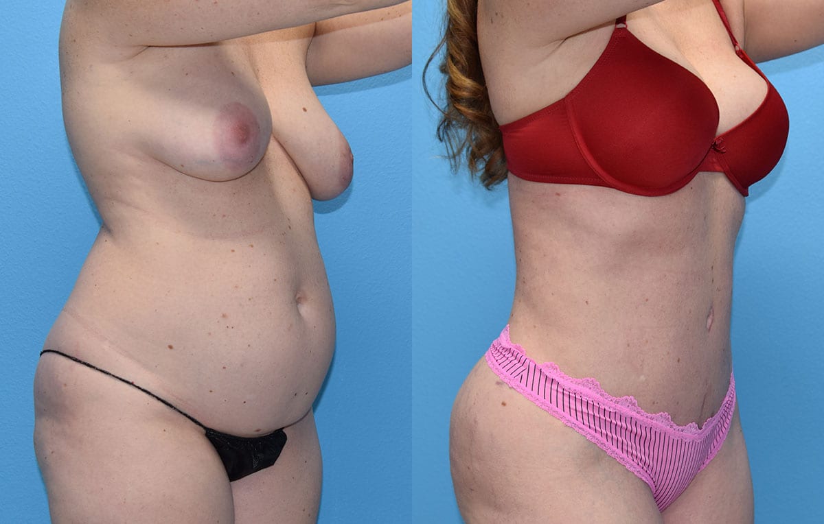 Tummy tuck results by Dr. Maningas at Maningas Cosmetic Surgery in Joplin, MO