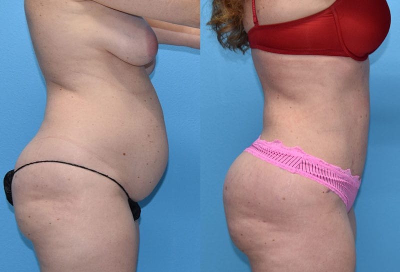 Tummy tuck results by Dr. Maningas at Maningas Cosmetic Surgery in Joplin, MO