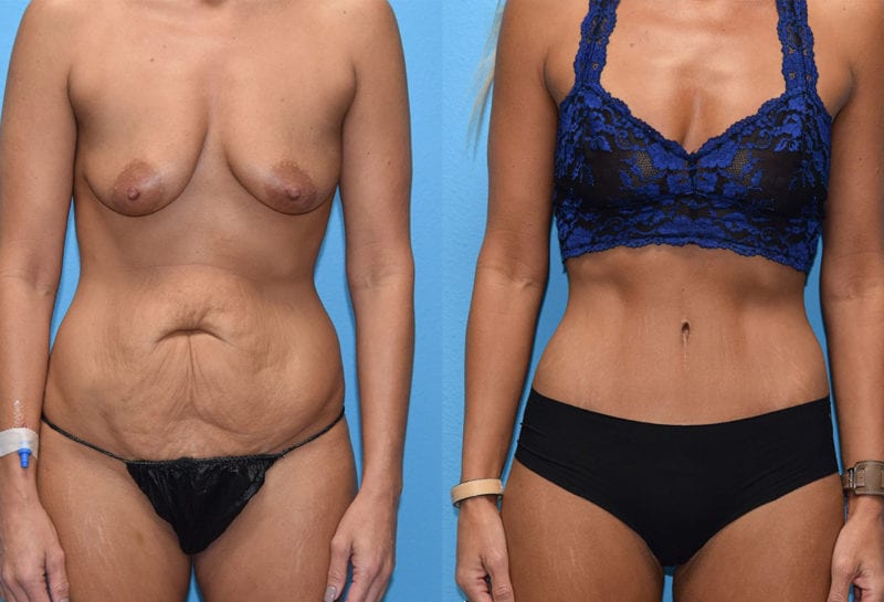 Tummy tuck results by Dr. Maningas at Maningas Cosmetic Surgery in Joplin, MO