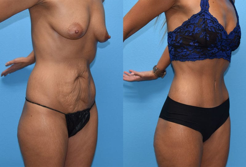 Tummy tuck results by Dr. Maningas at Maningas Cosmetic Surgery in Joplin, MO