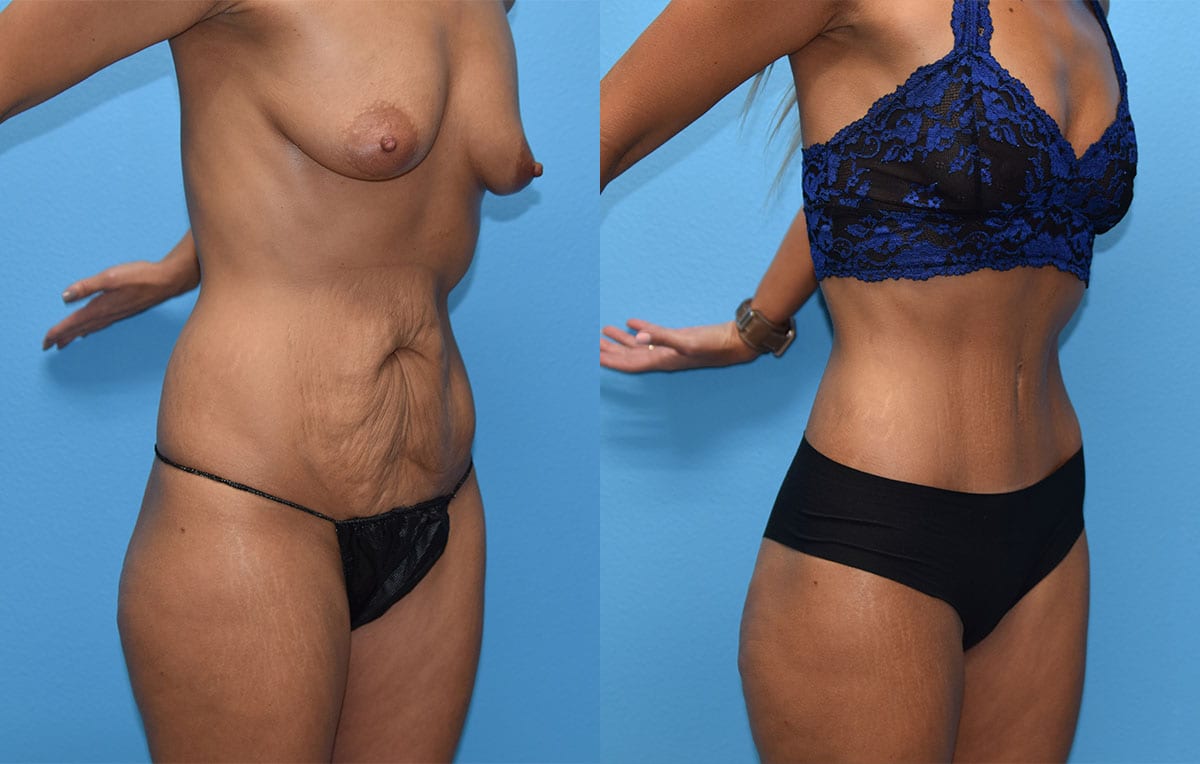 Tummy tuck results by Dr. Maningas at Maningas Cosmetic Surgery in Joplin, MO