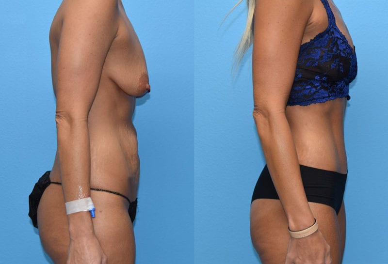 Tummy tuck results by Dr. Maningas at Maningas Cosmetic Surgery in Joplin, MO