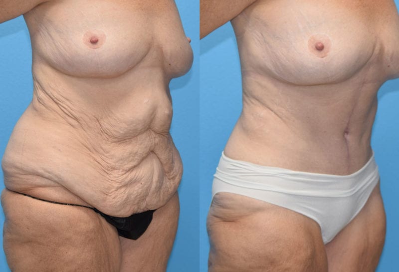 Fleur-de-lis Tummy tuck results by Dr. Maningas at Maningas Cosmetic Surgery in Joplin, MO