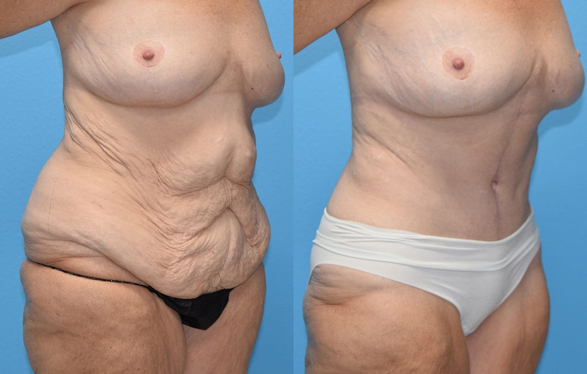 Fleur-de-lis Tummy tuck results by Dr. Maningas at Maningas Cosmetic Surgery in Joplin, MO