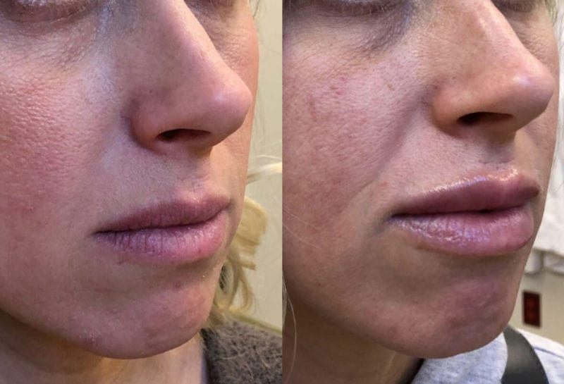 Lip Filler in Joplin, MO at Maningas Cosmetics Surgery