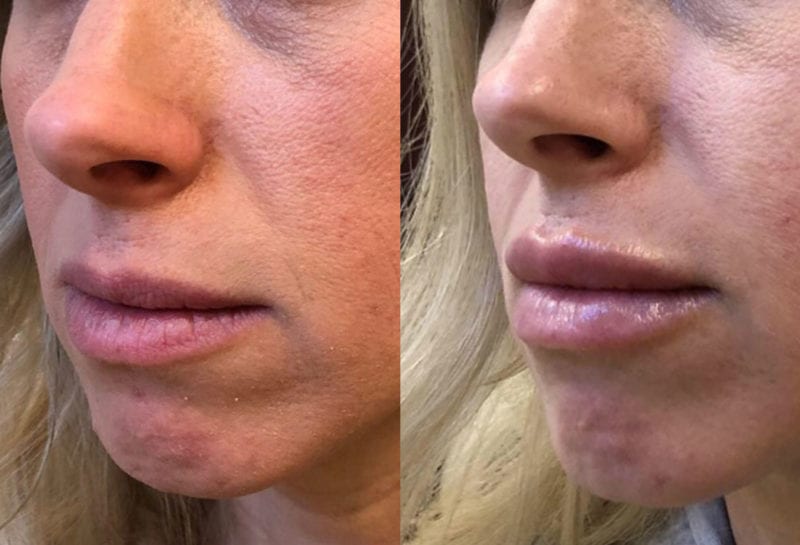 Lip Filler in Joplin, MO at Maningas Cosmetics Surgery