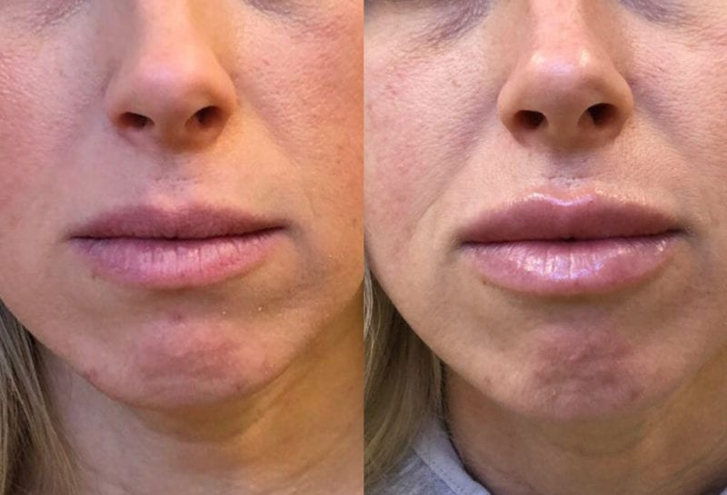 Lip Filler in Joplin, MO at Maningas Cosmetics Surgery