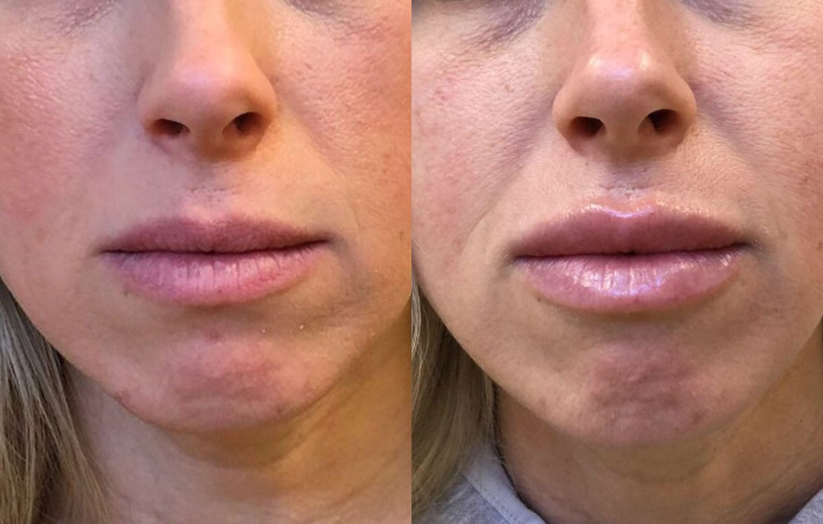 Lip Filler in Joplin, MO at Maningas Cosmetics Surgery